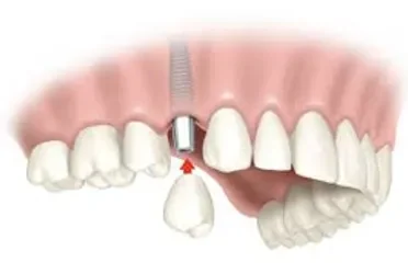 Implantes Dentales: La Solución Definitiva