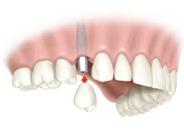 Implantes Dentales: La Solución Definitiva