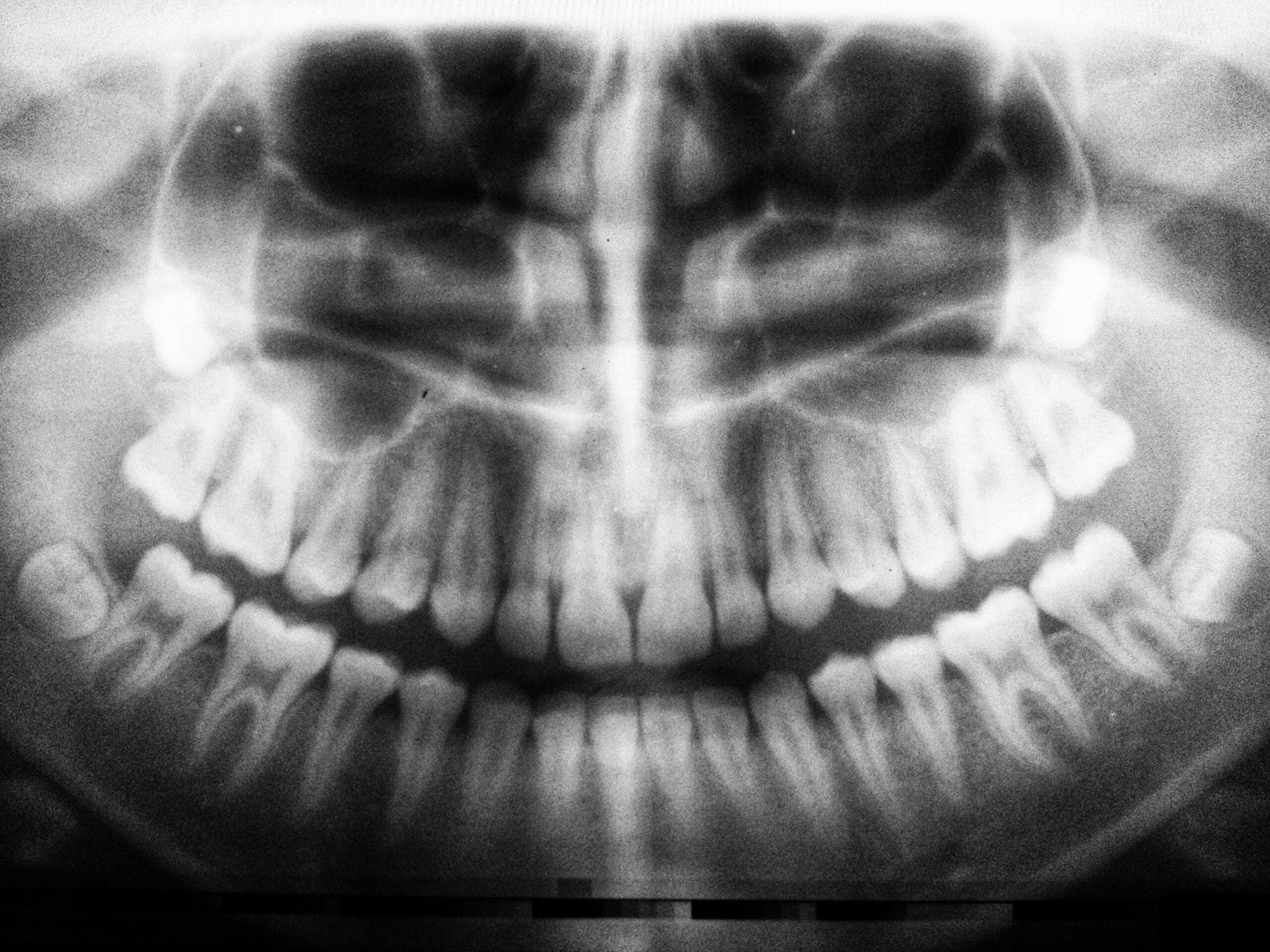 Guía Completa sobre Prótesis Dentales Removibles